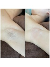 ビューティーサロン アンジュ(Ange)/脇ワックス脱毛