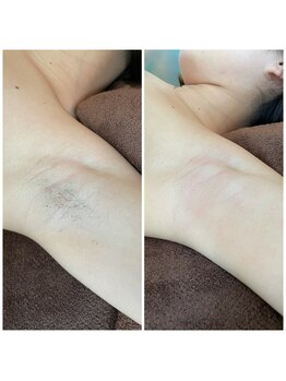 ビューティーサロン アンジュ(Ange)/脇ワックス脱毛