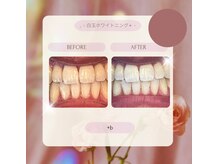 プラスビーセルフ(+b self)/ホワイトニングビフォーアフター