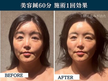 シンク(CINQ)/美容鍼灸60分小顔効果つや肌