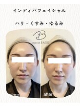 インディバ ベース(INDIBA BASE)/インディバフェイシャル