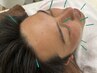 【メンズ美容鍼】男性専用美容鍼コース60分/美容/首肩頭のこり/眼精疲労◎
