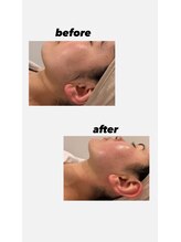 ウネ 吉祥寺(une)/大人気！お顔シュガーリング