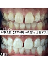 ホワイト 福岡天神店(WHITE)/ホワイトニングビフォーアフター