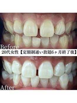 ホワイト 福岡天神店(WHITE)/ホワイトニングビフォーアフター
