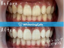 ホワイトニングカフェ 豊中店(WhiteningCafe)/◎歯のホワイトニング施術写真◎