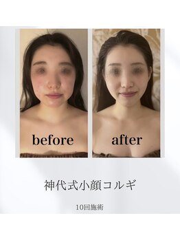 サリーエミリー 船橋店(SallyEmiry)/小顔コルギ10回の効果です。