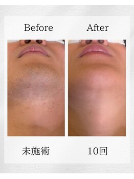 スキンスタジオトウキョウ(SKIN STUDIO TOKYO)/ヒゲ脱毛10回