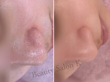 ケイ(K)/毛穴｜いちご鼻・鼻の黒ずみ