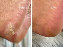 爪のいろは/フットケア　足裏　角質ケア