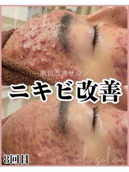 エムケーサロン(MK salon)/ニキビケア#剥離なしピーリング