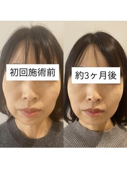 リアプア(Li'a)/【40代女性】3ヵ月変化 小顔