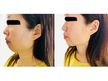 サロンモコ(Salon Moco)の雰囲気（エクソソーム/肌質改善/美容再生/たるみケア/小顔）