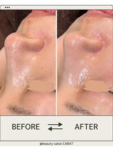 カラット(CARAT)/ダクトピール×ヒト幹細胞マスク