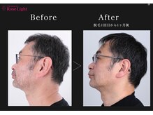 ヘルディン(heldin +555)/メンズ脱毛