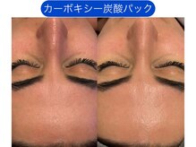 クレヴィア バイ サイバーエステ(CREBIA)/【くすみ改善/透明感を高める】