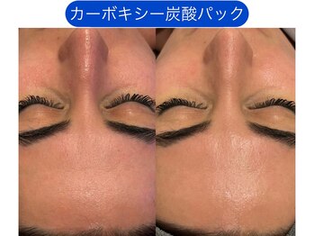 クレヴィア バイ サイバーエステ(CREBIA)/【くすみ改善/透明感を高める】