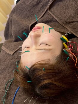 わせだのもり整骨院の写真/【全身鍼灸・美容鍼で細胞から活性化！】身体の不調の改善に対してさまざまな効果があります☆