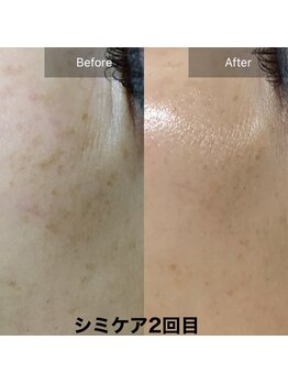 んまち/シミ改善