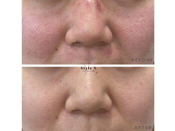 スタイルエヌ バイナース(Style N. by nurse)/毛穴毛穴毛穴!毛穴にはこれ!20代