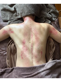 トータルケアサロン リトルサン(Little Sun)/デトックスに有効な膀胱系かっさ