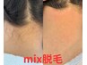 【うなじmix脱毛】(シュガーリング+光脱毛)ツルスベうなじの期間が超長持ち☆