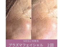 ステラティエ(Stellatier)の雰囲気（肌を整えたい！キープしたいなら！【プラズマフェイシャル】）