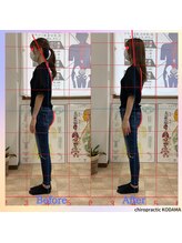 カイロプラクティック コダマ(KODAMA)/姿勢矯正　ビフォーアフター