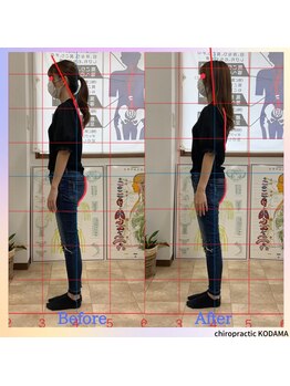 カイロプラクティック コダマ(KODAMA)/姿勢矯正　ビフォーアフター