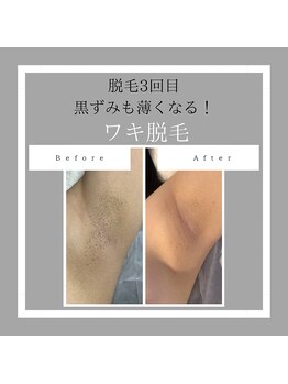 ロカヒ(Lokahi)/脇脱毛3回で黒ずみ改善♪