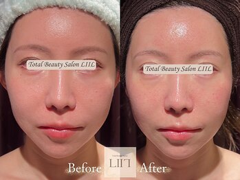 エル 麻布十番/たるみ/小顔/毛穴/フェイシャル