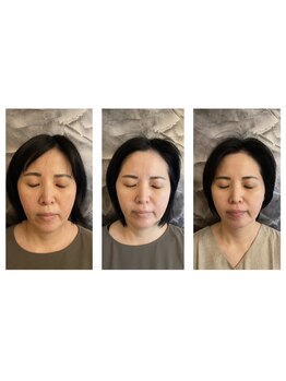 リモド(Rimodo509)/小顔矯正(ヘッドスパ