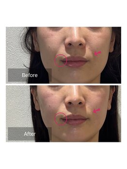 ウル(ulu)/電気を流す美容鍼1回♪