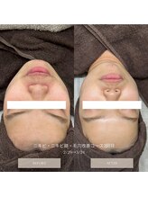 タグ 高知駅前店(Tug)/【毛穴・ニキビケア・肌質改善】