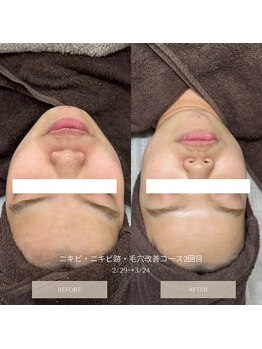 タグ 高知駅前店(Tug)/【毛穴・ニキビケア・肌質改善】