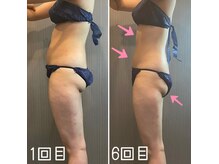 ガーデン(Garden)/痩身施術前後
