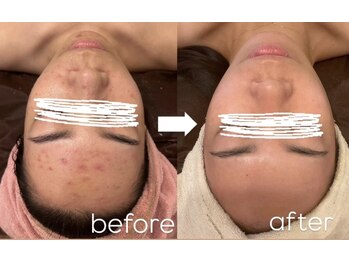 ナルシス(Narcissus)/ＲＥＶＩ施術before→After 