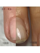 アネリー(ANERY.)/自爪育成・深爪育成