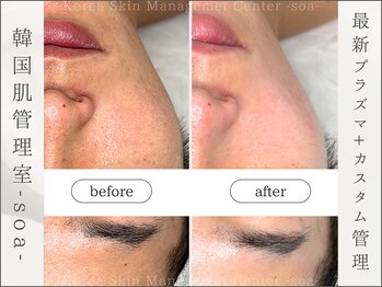 韓国肌管理室 ソア(soa)/【最新プラズマ+カスタム管理】
