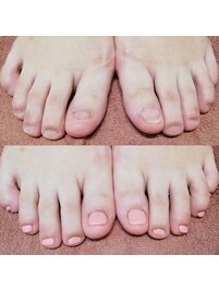 深爪矯正/長さ出し/フットケア