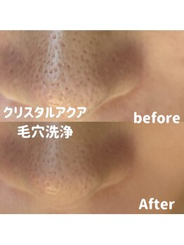 ブルームーン(BLUE MOON)/毛穴洗浄