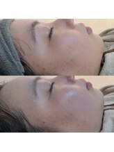 ビーマジック(Be Magic)/毛穴洗浄♪