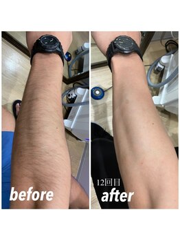 セルフ脱毛サロン SELFMADE イオンタウン仙台泉大沢店【3/29 NEW OPEN(予定)】 /【ビフォーアフター】セルフ脱毛