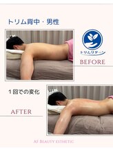 エーエフビューティーエステ(AF Beauty Esthetic)/トリム背中