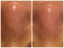 ロータス(LOTUS)/ハイドロ毛穴洗浄