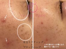サロンヴェアリー 広尾(salon vary)/水玉＋ブラックハーブピーリング