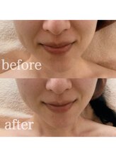 ブランシェ 高岡店 × 椿/シワ・たるみケア『30代お客様』