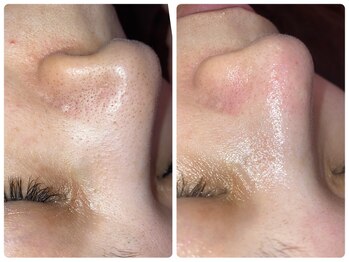 エルマナ(Hermana)/毛穴ケアビフォーアフター