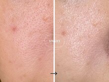 スワン 大阪南堀江(swan)/開いた毛穴を改善したい方