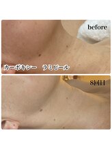 ルマエクレ(rmaecla)/首のシワ改善